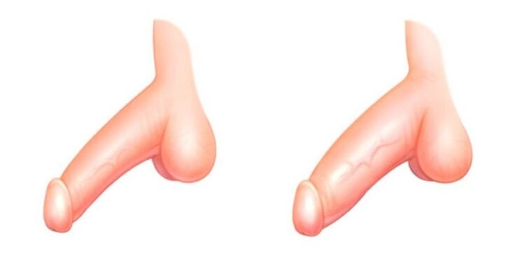 penis przed i po powiększeniu